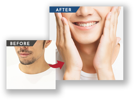 ヒゲビフォーアフター